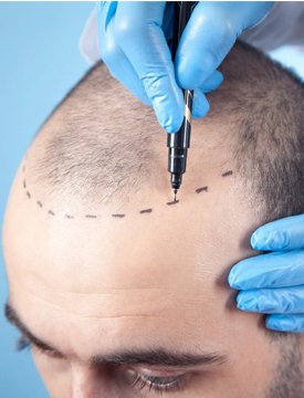 hair procedure dr zobia mehmood