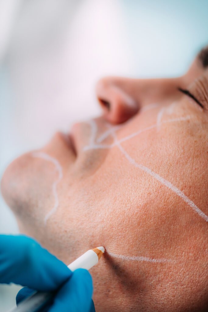 Dermal Fillers for Men. Marking Man’s Face Before Dermal Filler Treatment